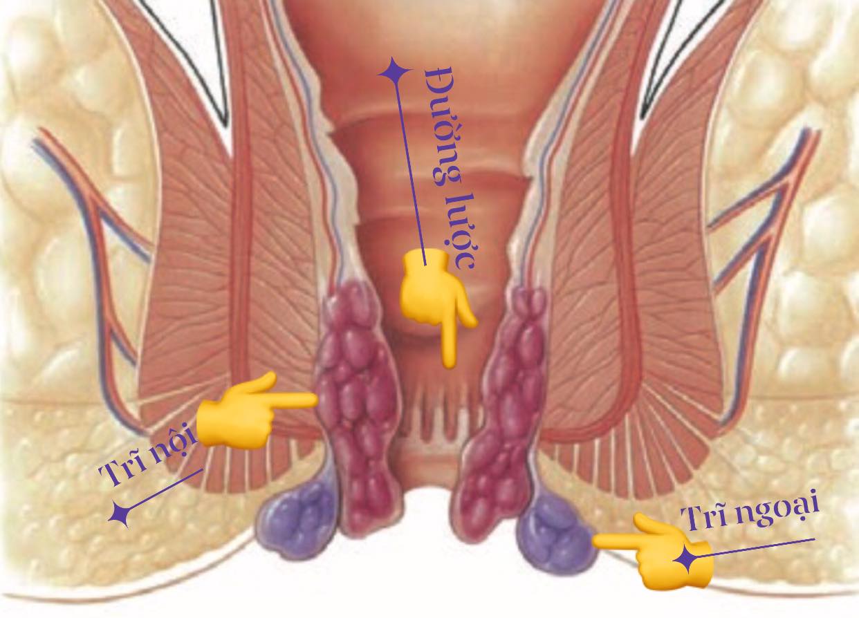  BỆNH TRĨ & CÁC PHƯƠNG PHÁP ĐIỀU TRỊ